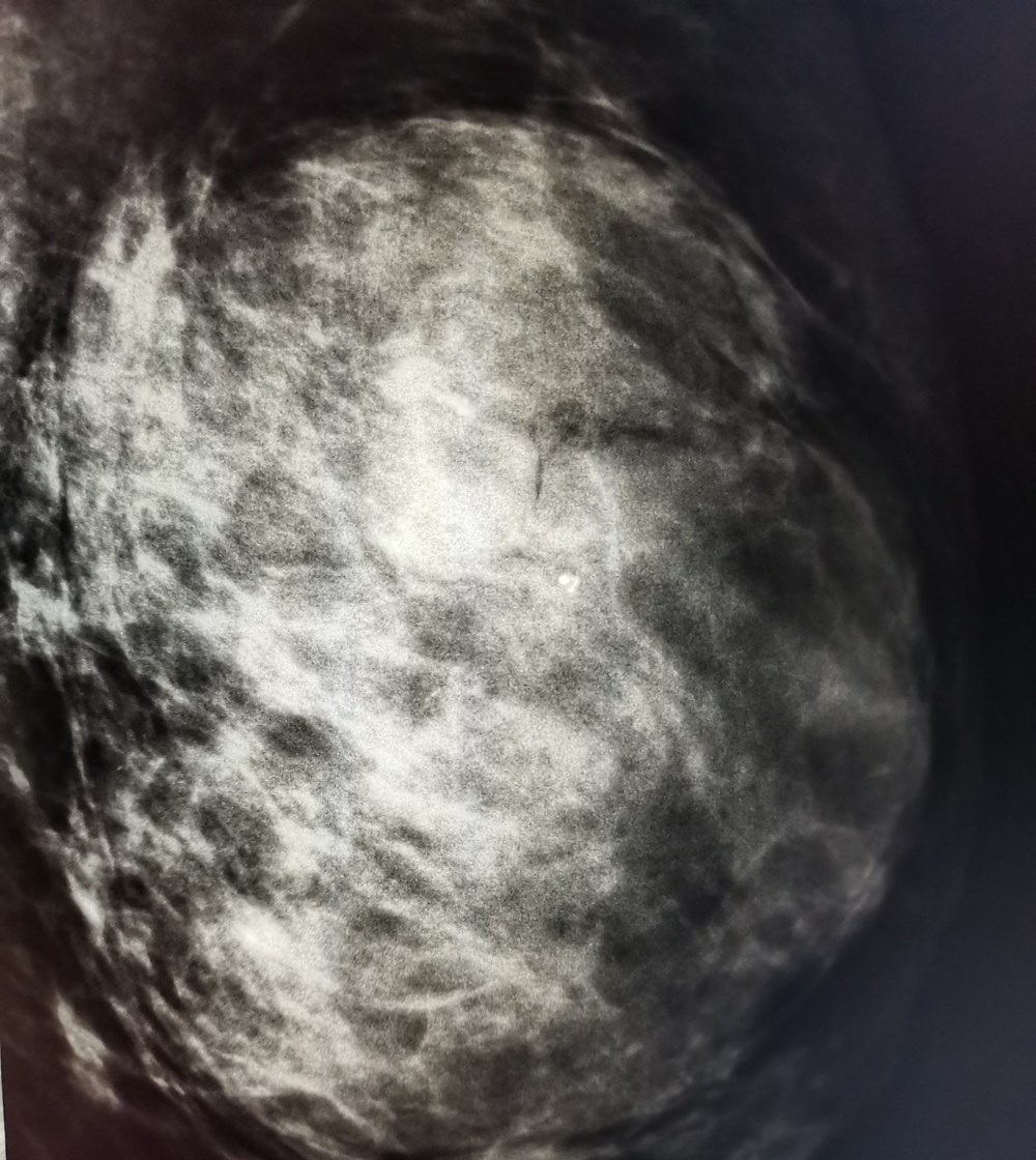 Mammogram, MLO view, with an example region of interest marked