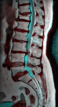 Sagittal T2 MR image of the lumbar spine